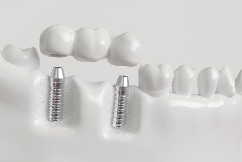 dental implant bridge
