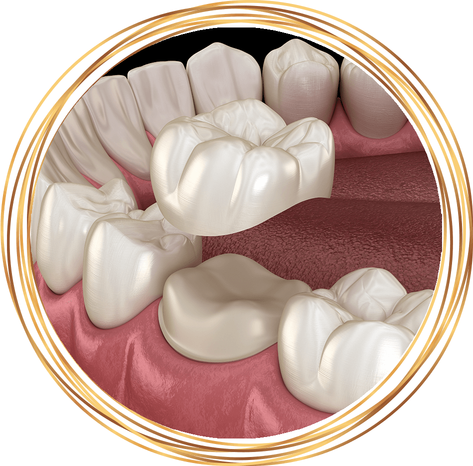 dental crown