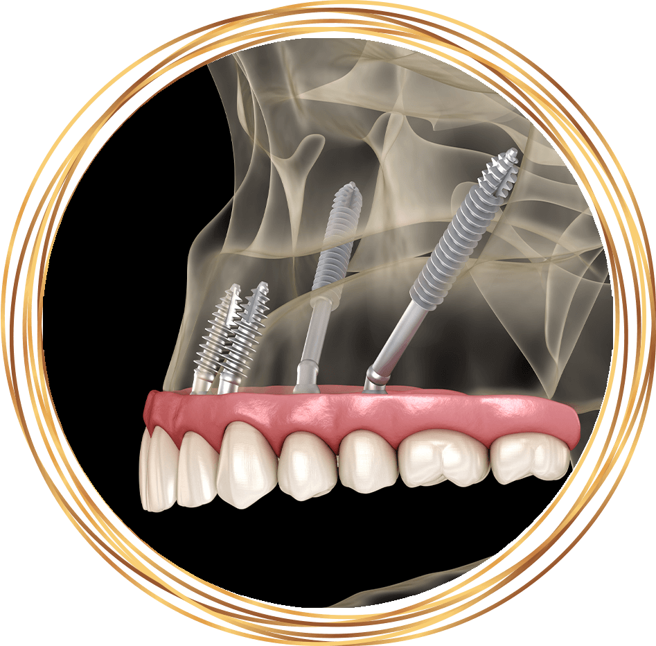 zygomatic dental implants 3d rendering